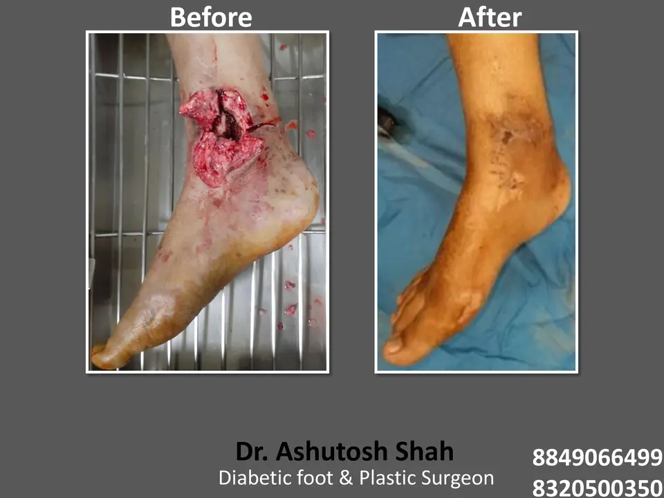 Diabetic Foot  PPT sunita.pptx-58.webp